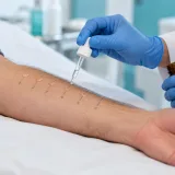 Profesional con guantes aplicando gotas de extracto de alérgenos sobre el antebrazo de un paciente durante un prick test